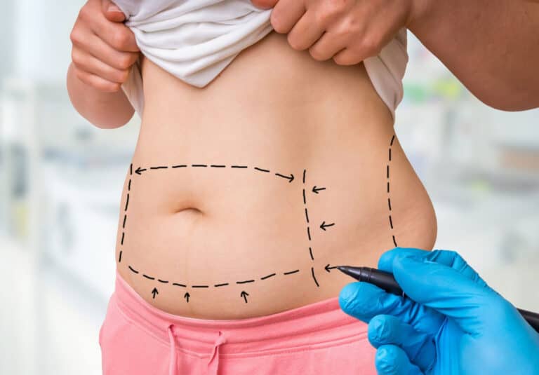 How Liposuction Helps You Achieve Body Contours