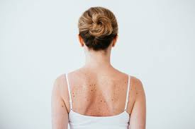 The Importance of Skin Cancer Screenings for Early Detection
