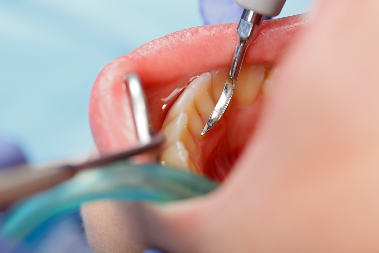 General Dentistry Tips for Maintaining Healthy Gums