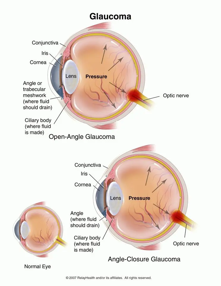 Glaucoma and Its Connection to Other Health Conditions