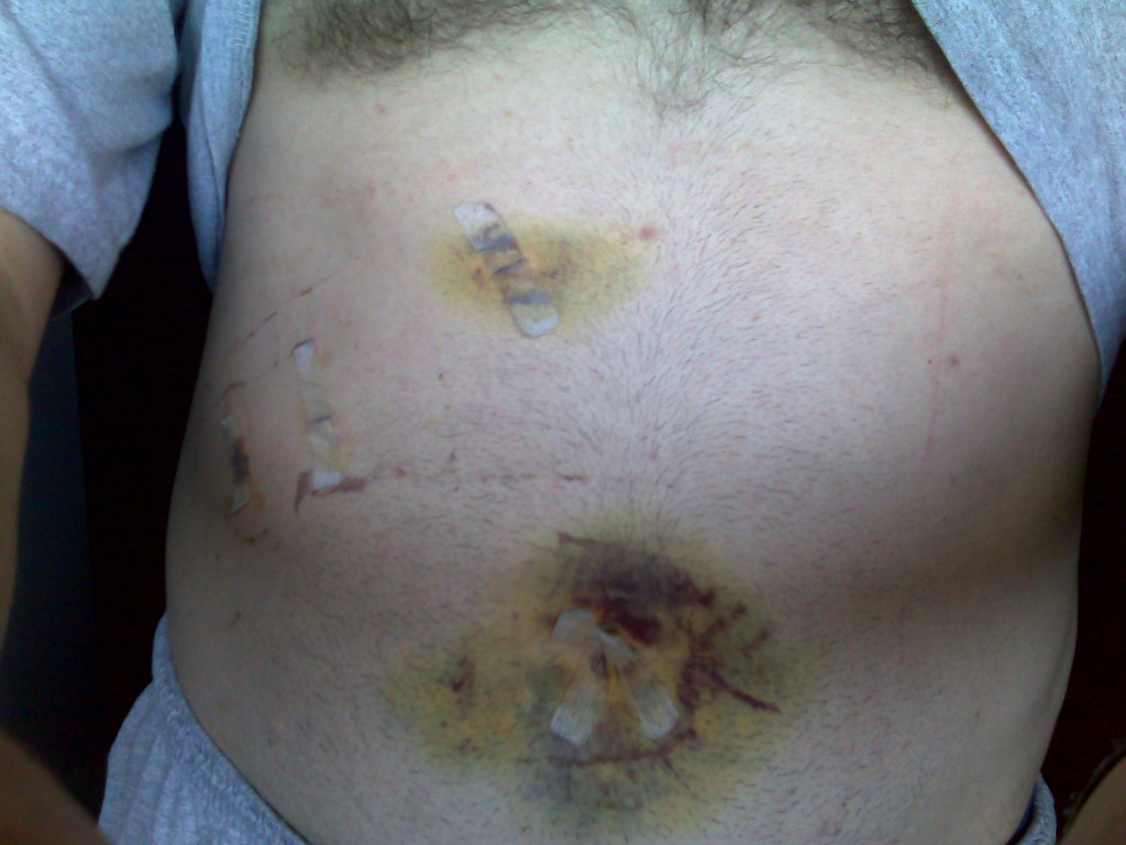 Symptoms Indicating You Might Need Gallbladder Surgery