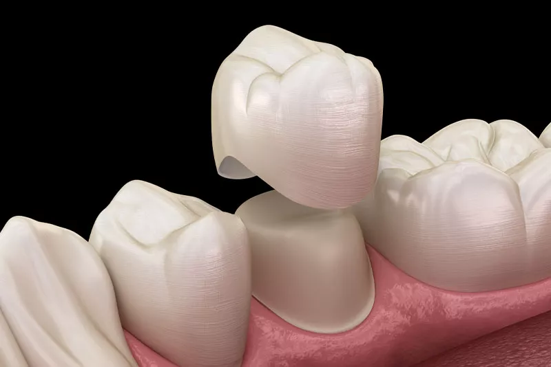 The Advantages of Dental Crowns in Restoring Function