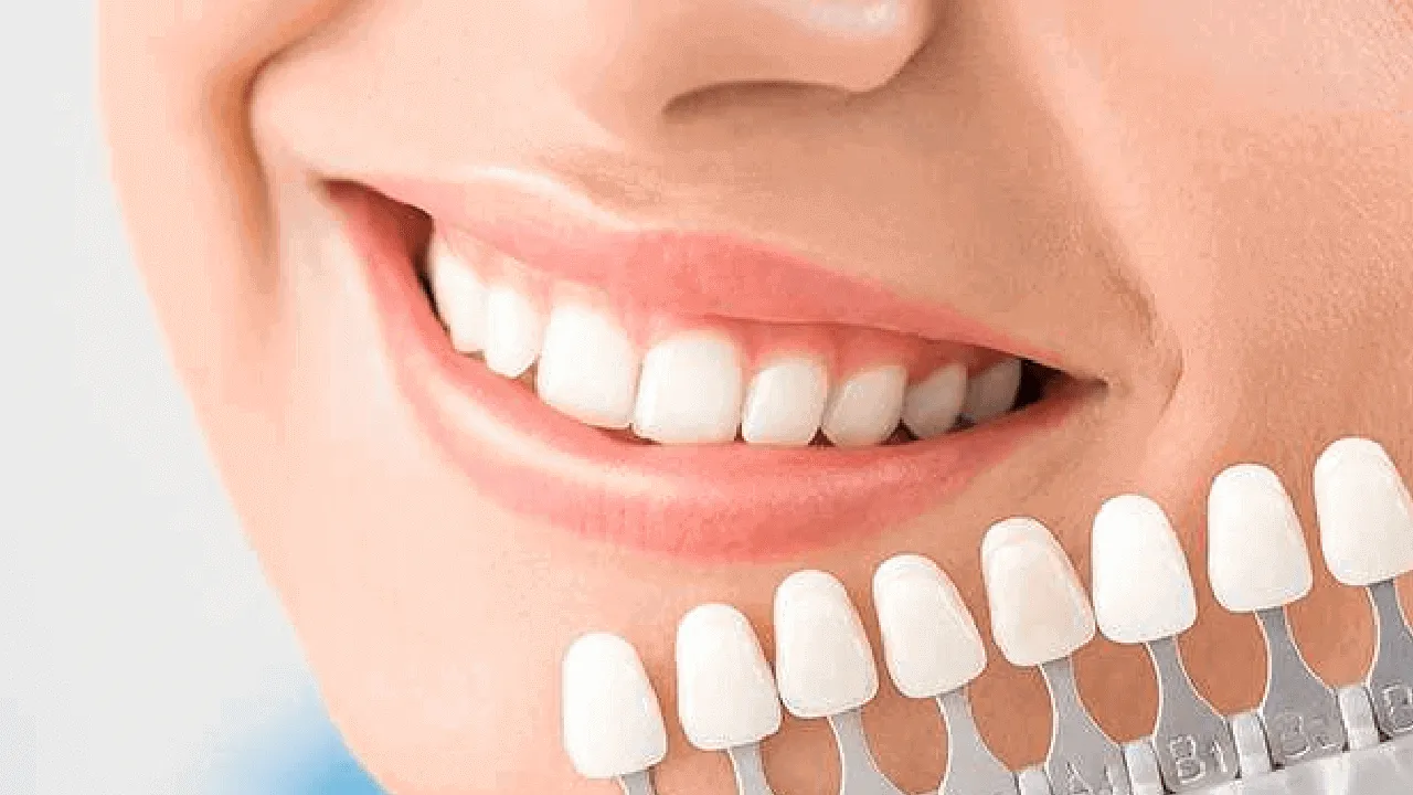 The Aesthetic Appeal of Veneers: Transforming Your Smile