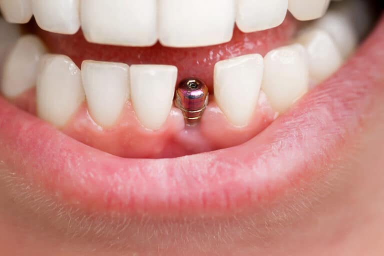 The Benefits of Dental Implants for Oral Issues