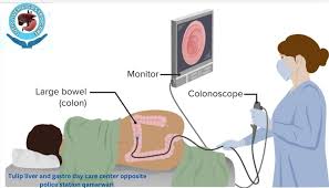 The Technology Behind Modern Colonoscopy Procedures