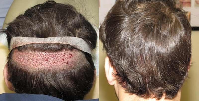 Tips for Post-Hair Transplant Care