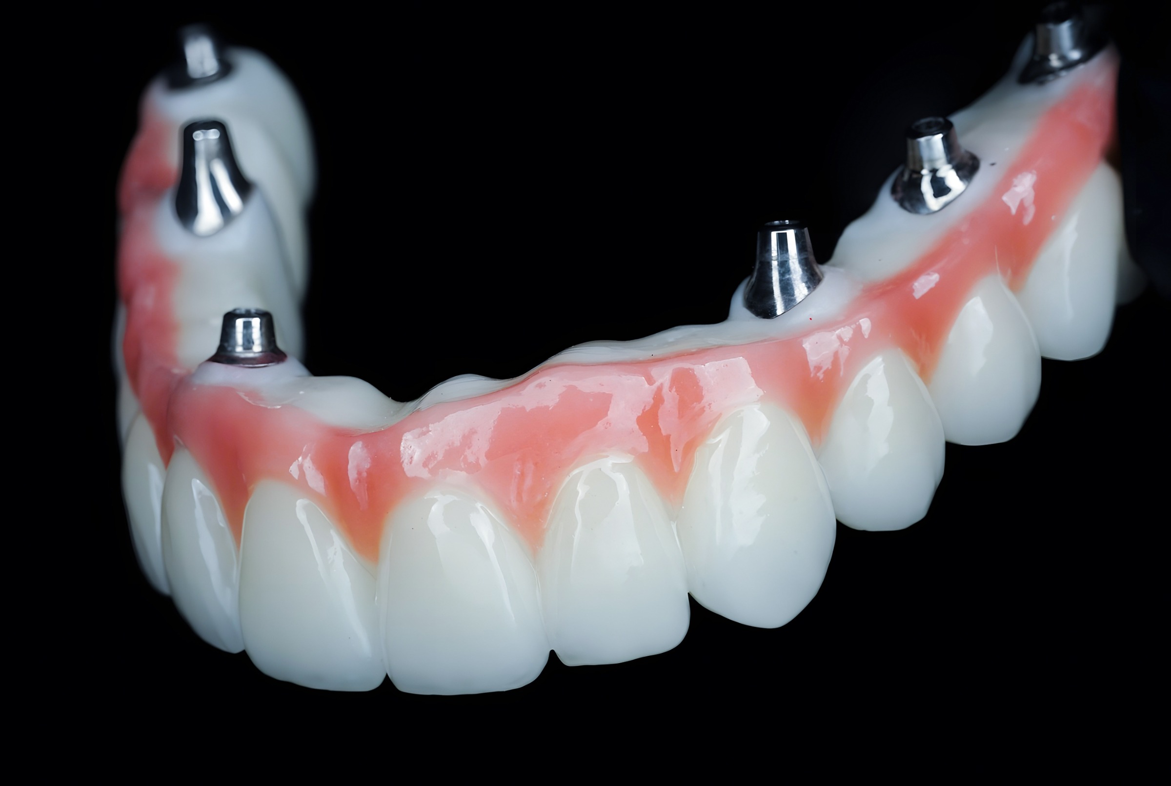 What To Know About the All-In-X Dental Implants Procedure