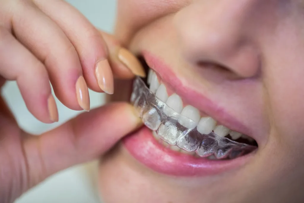 What is the Invisalign Treatment Timeline