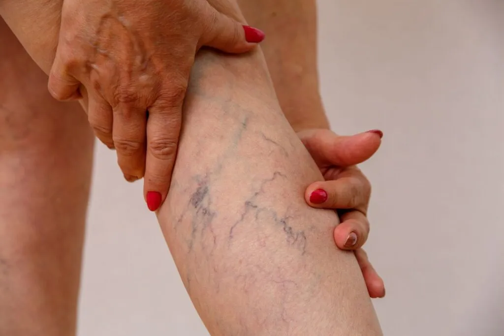 The Importance of Early Detection in Chronic Venous Insufficiency