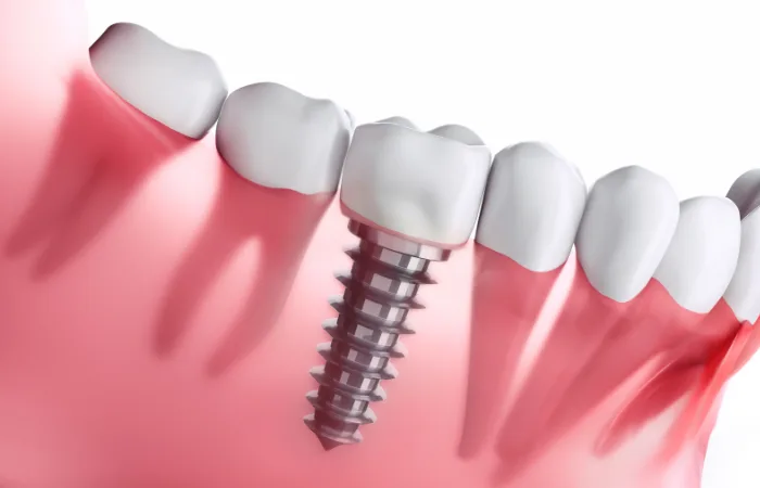 The Latest Innovations in Dental Implants